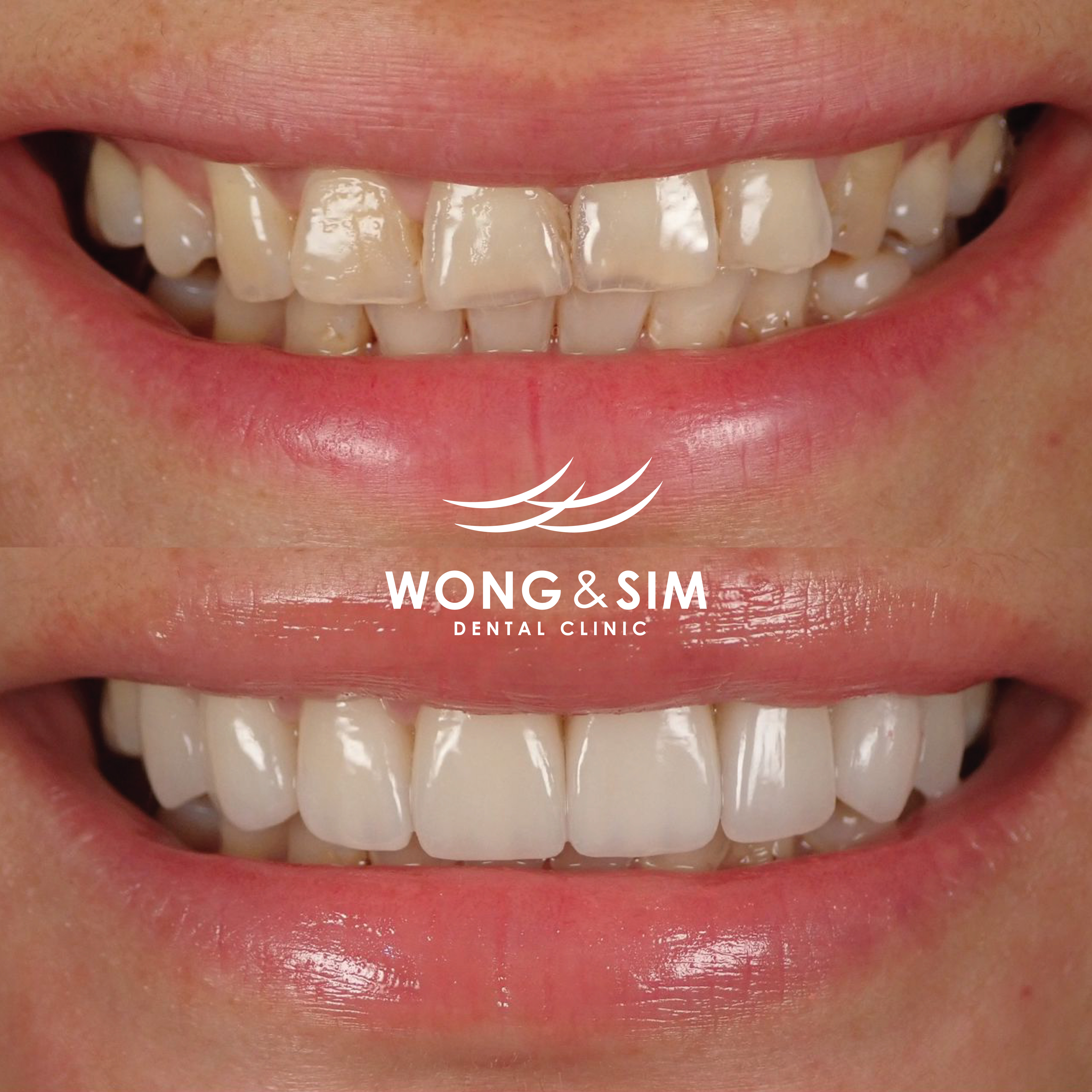 Patient 5 - Smile Makeover Before and After